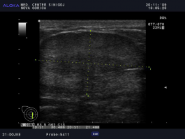 Ultrazvok kože - tumor dojke pri moškem 2